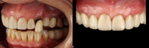 Dental Implant Example