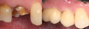 Dental Impant Example 2