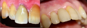 Dental Implants Exmaple 3