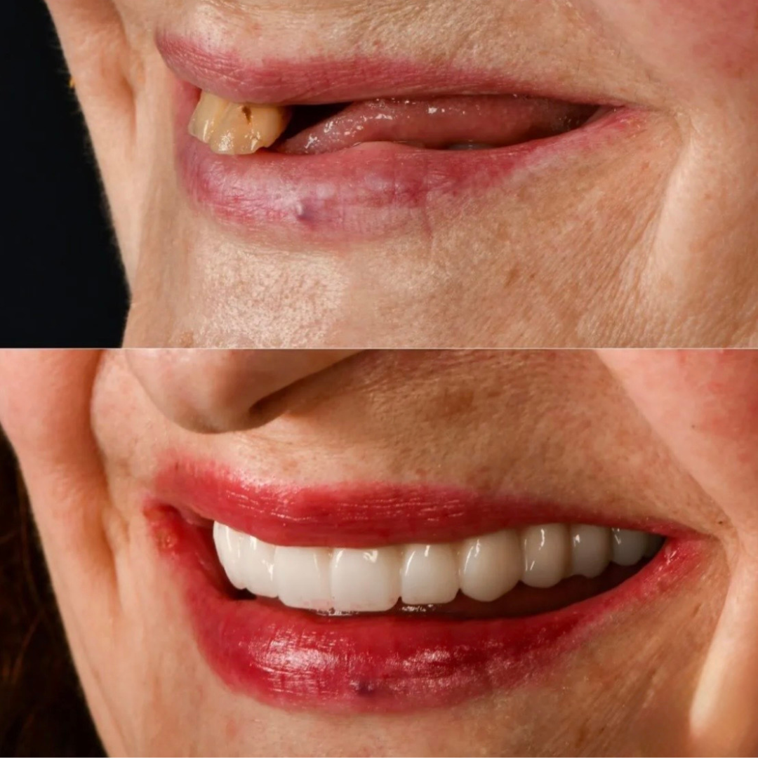 BLK_Implants and Crowns 2_Marcio Maia_ DEN0002550599.jpg