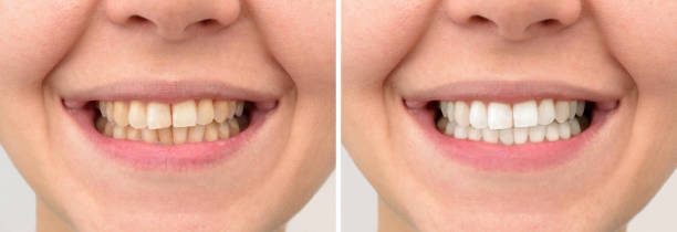 Teeth Whitening Image