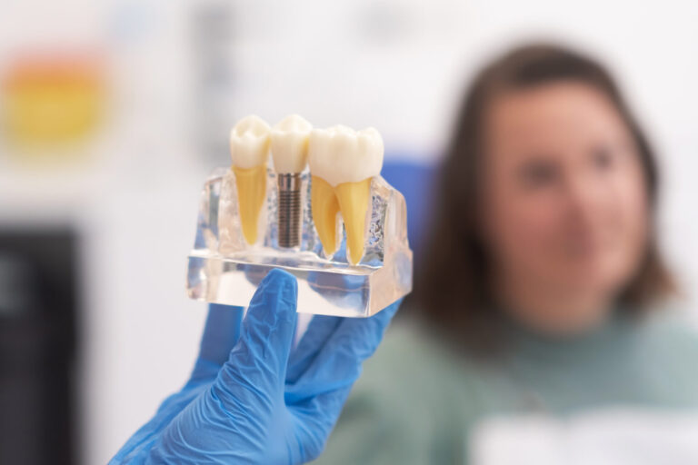 Dental implants